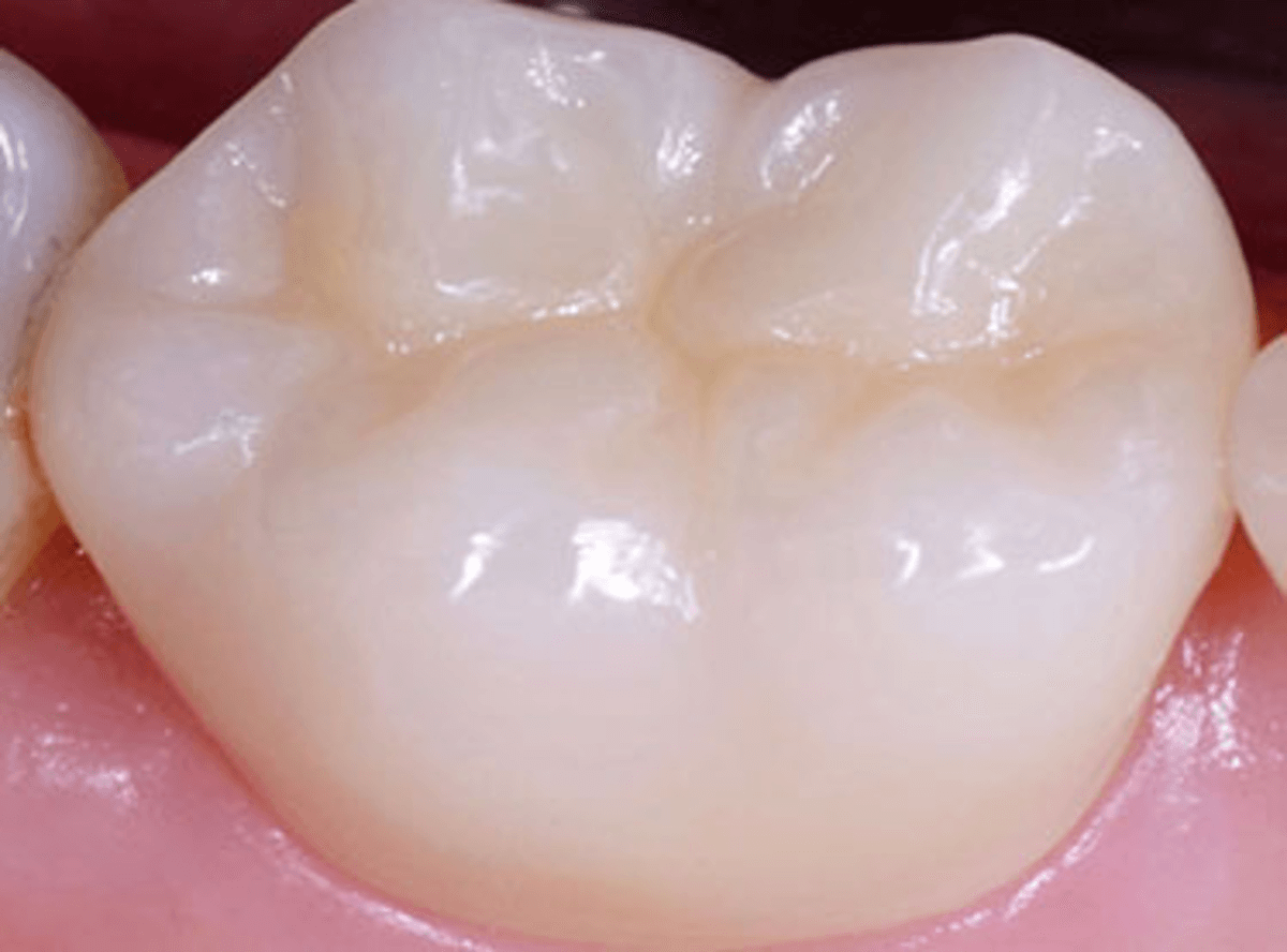 Tooth-Colored Aesthetic Filling