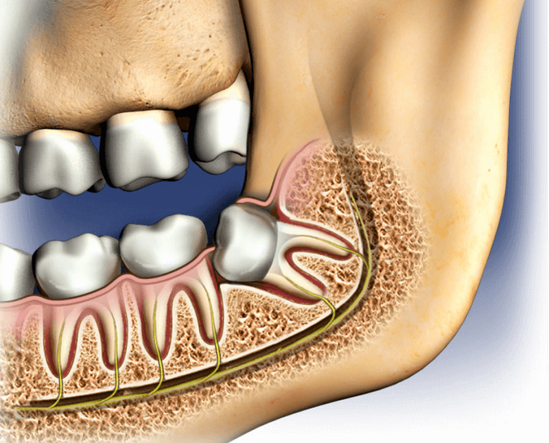 Wisdom Tooth Extraction